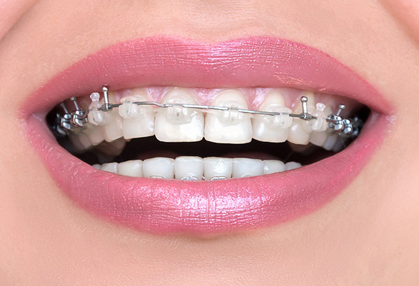 brackets-esteticos brackets-esteticos