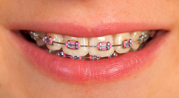 brackets-metalicos brackets-metalicos