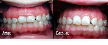 AGRANDAMIENTO GINGIVAL AGRANDAMIENTO GINGIVAL