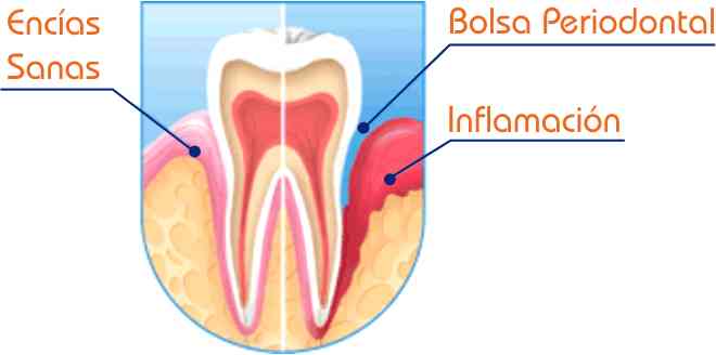 bolsa periodontal bolsa periodontal