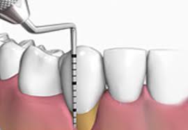 periodoncia-limpieza periodoncia-limpieza