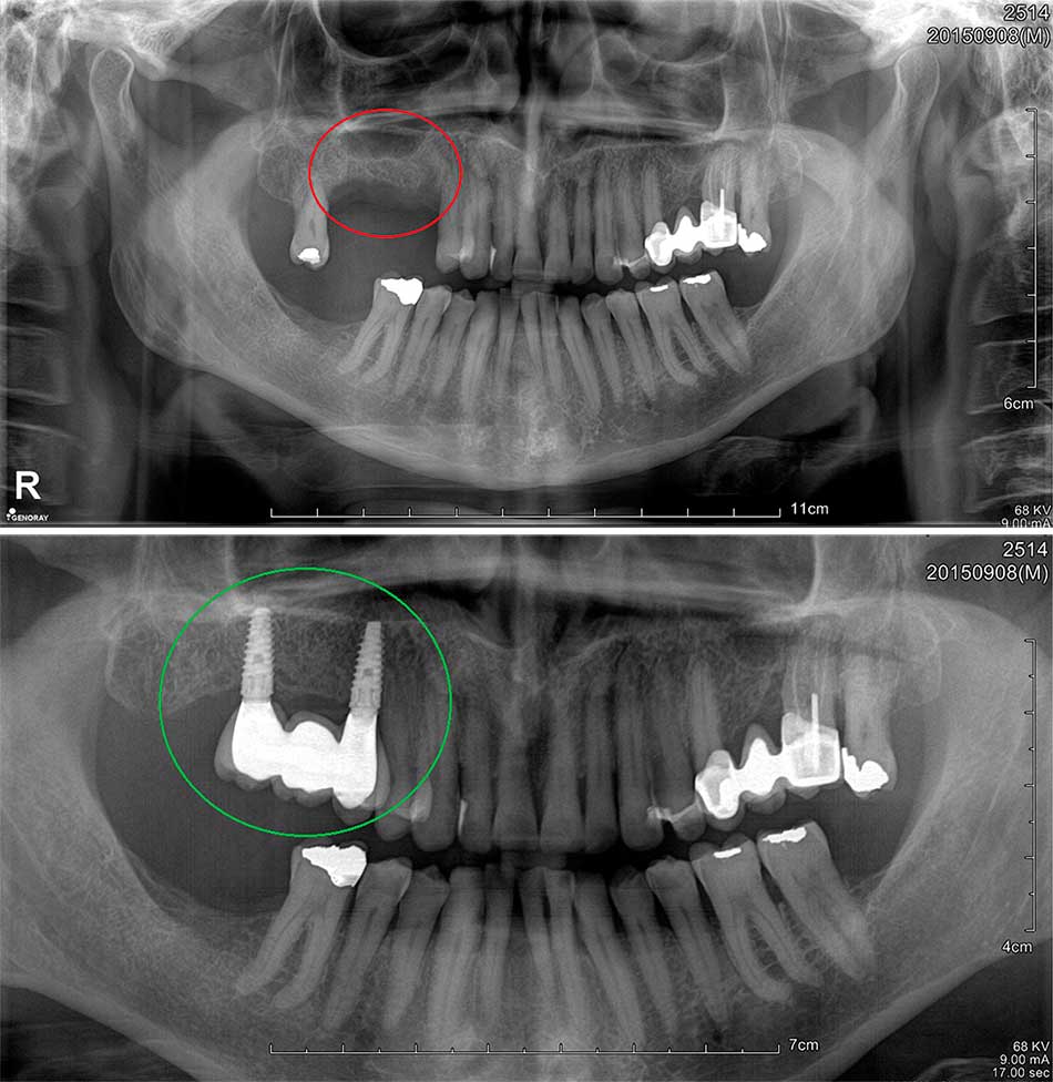 Implantes dentales radiografía