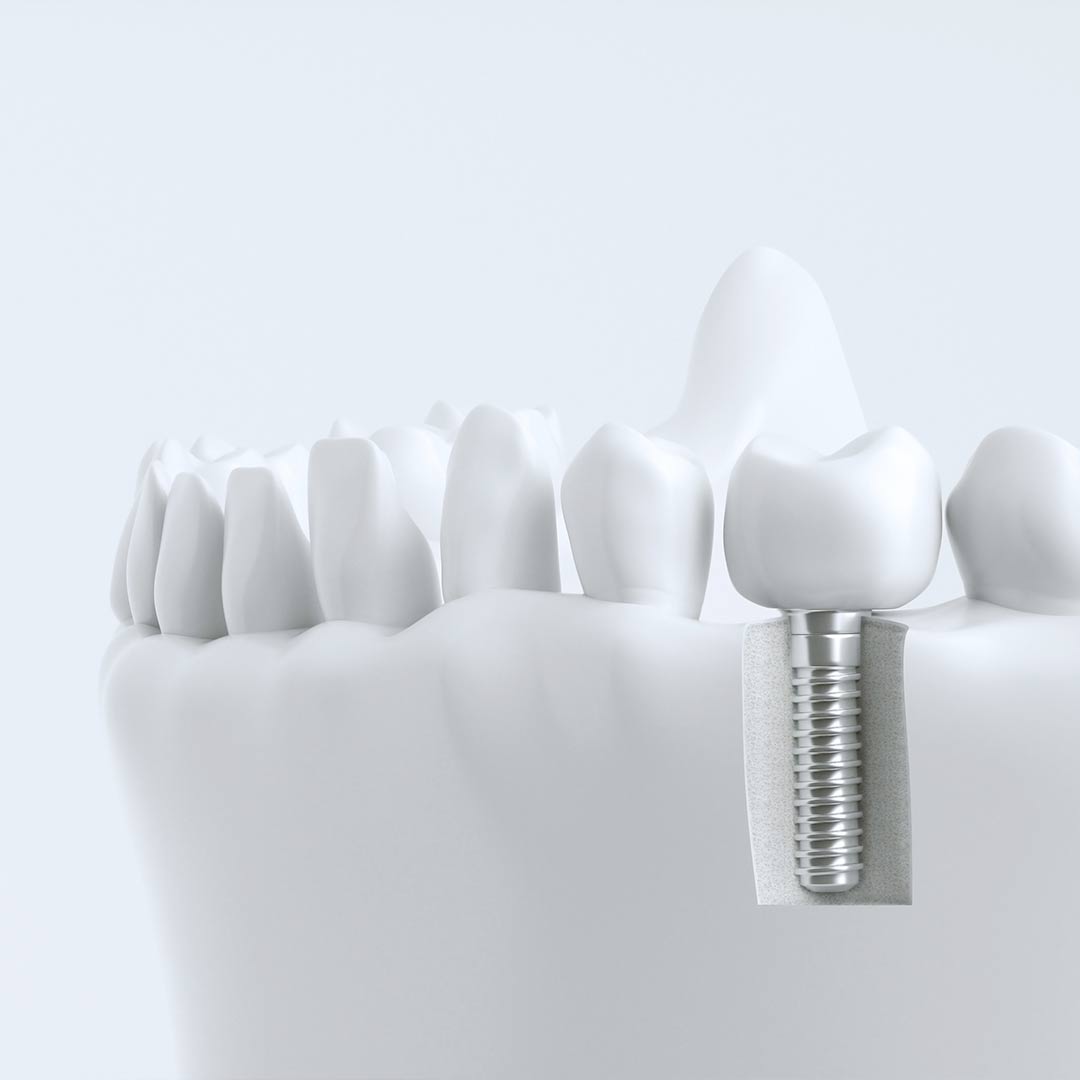 Implantes dentales