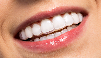 Estética Invisalign