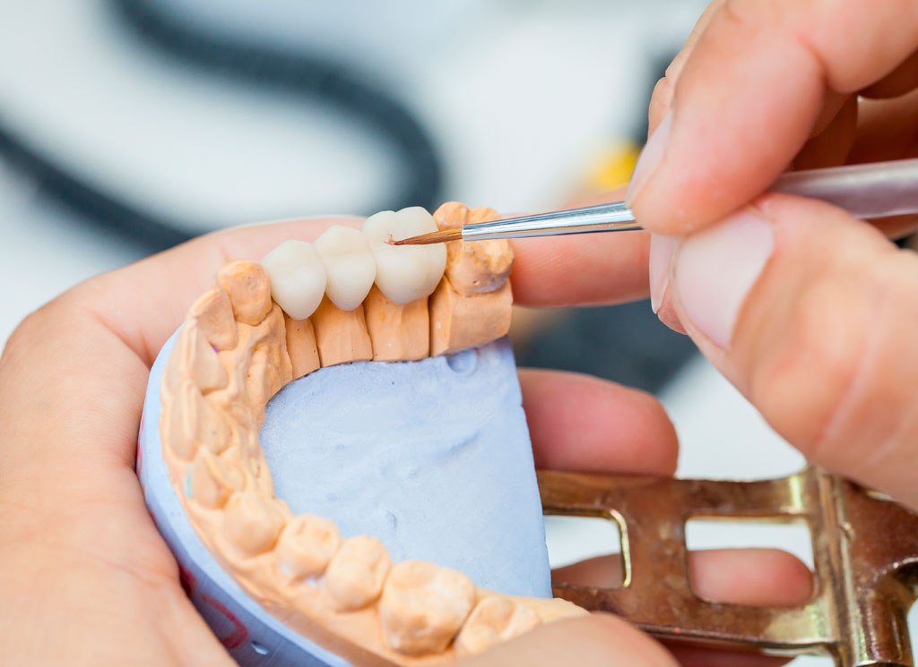 Prótesis dentales personalizadas