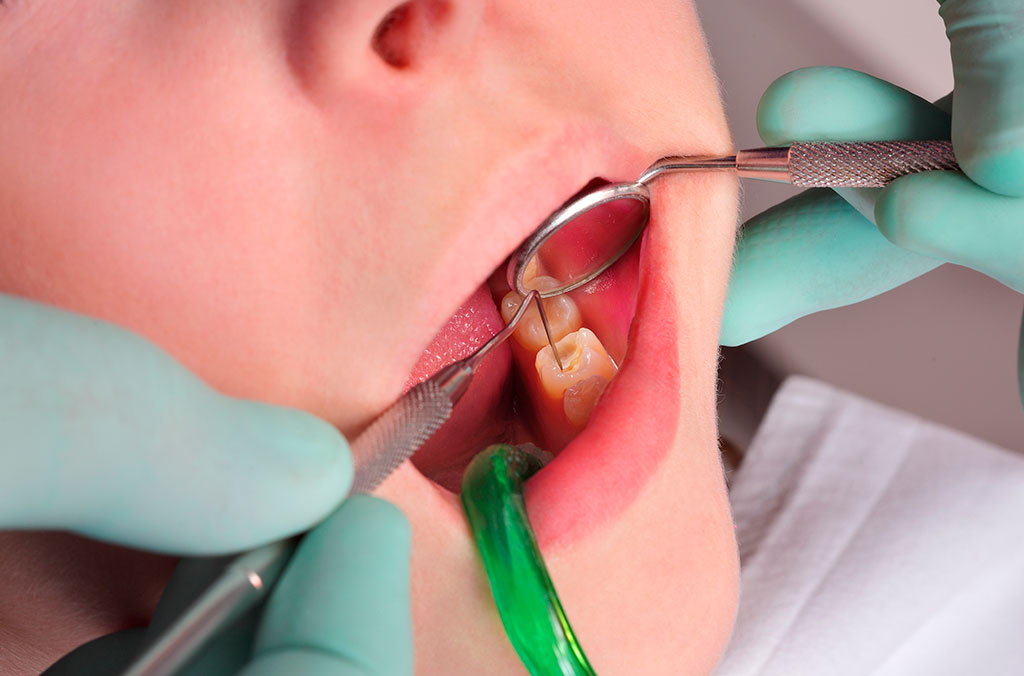 Tratamiento de la caries dental