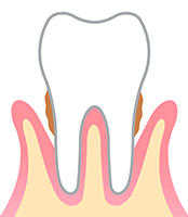 Gingivitis tratamiento