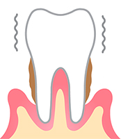 Periodontitis tratamiento