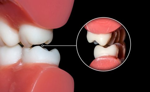 Oclusión-dental