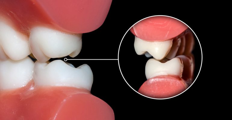 Oclusión-dental