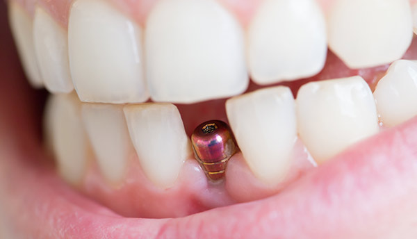 Implante dental colocado en la boca