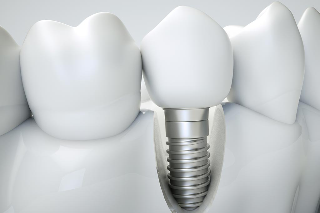 Proceso de osteointegración implantes dentales