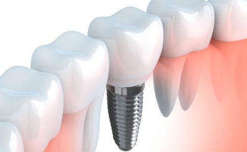 Duración-implantes-dentales