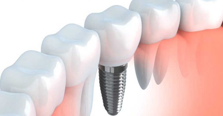 Duración-implantes-dentales