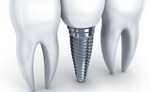 Implantes-Dentales-funciones