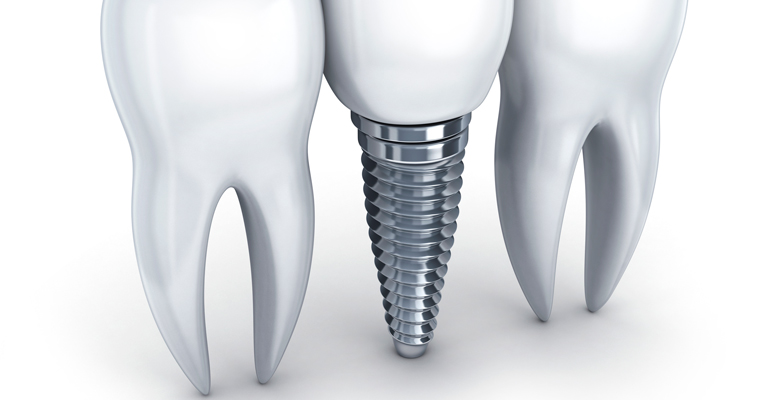 Implantes-Dentales-funciones