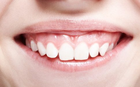 Sonrisa-gingival-tratamiento