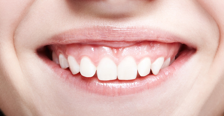 Sonrisa-gingival-tratamiento