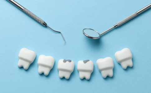 dientes-con-caries-dentales