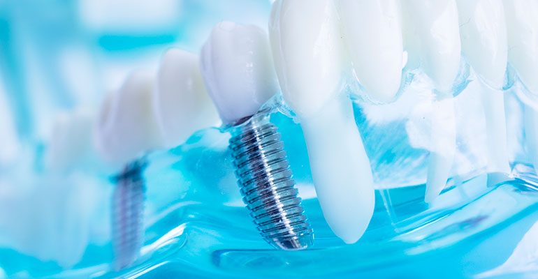 ¿Por qué motivos puede moverse un implante dental?