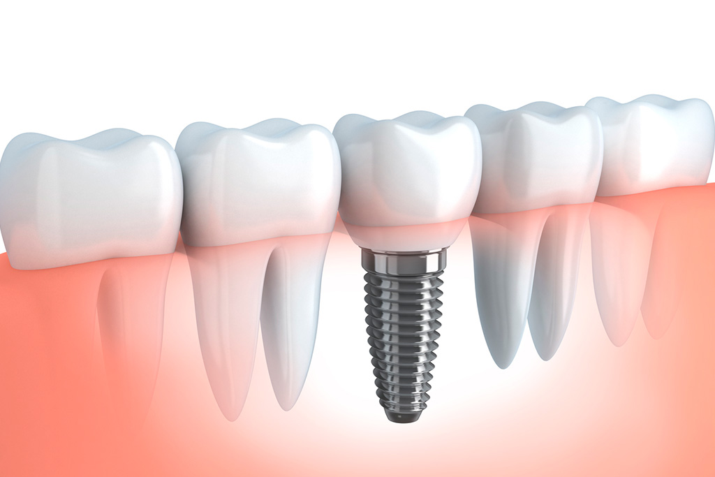 Periimplantitis: síntomas y causas