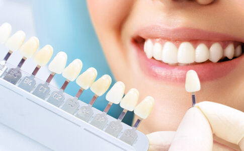 Imagen que muestra la sonrisa de una chica con una paleta de dientes don diferentes tonos de blanco