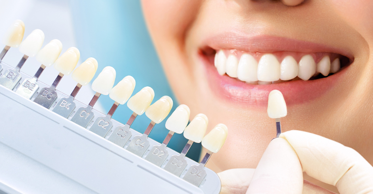 Imagen que muestra la sonrisa de una chica con una paleta de dientes don diferentes tonos de blanco