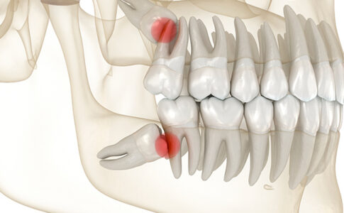 mandíbula con dientes impactados