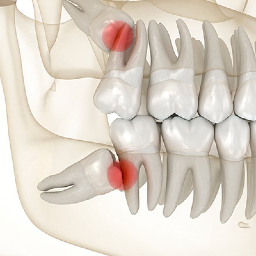 Qué son los dientes impactados y tratamiento