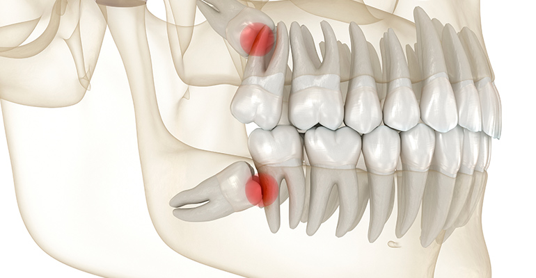 mandíbula con dientes impactados