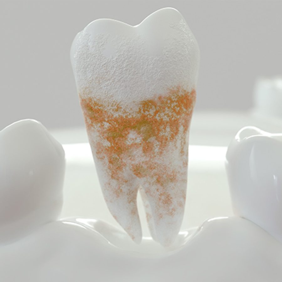 ¿Qué es la placa dental? Consejos para prevenirla.