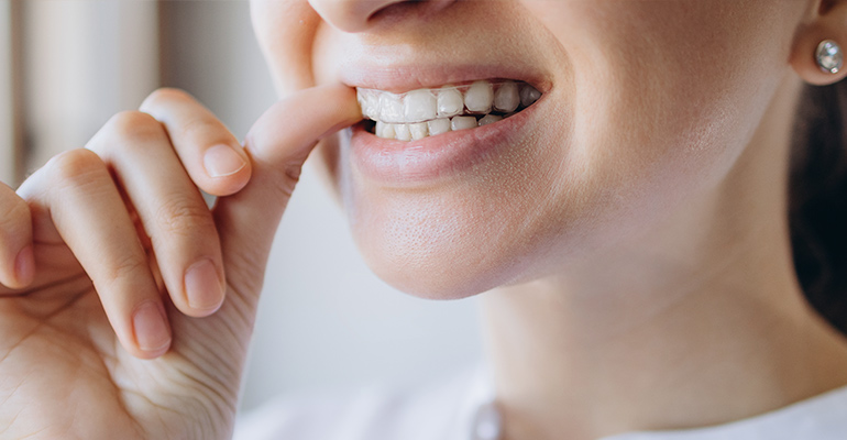 Mujer con férula por dientes desgastados por bruxismo