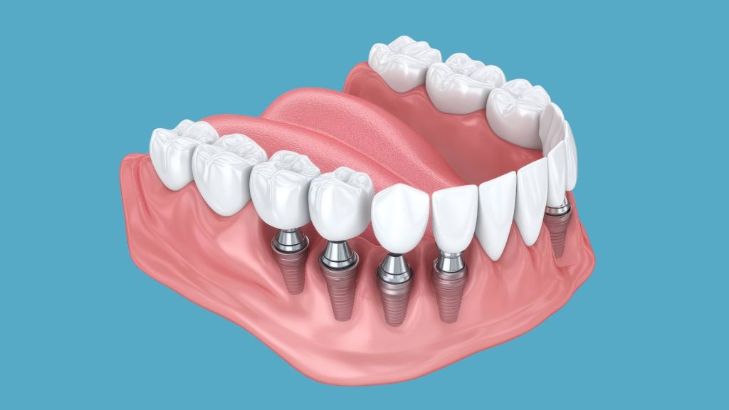 postoperatorio implante dental