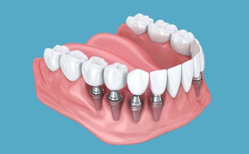 postoperatorio implante dental