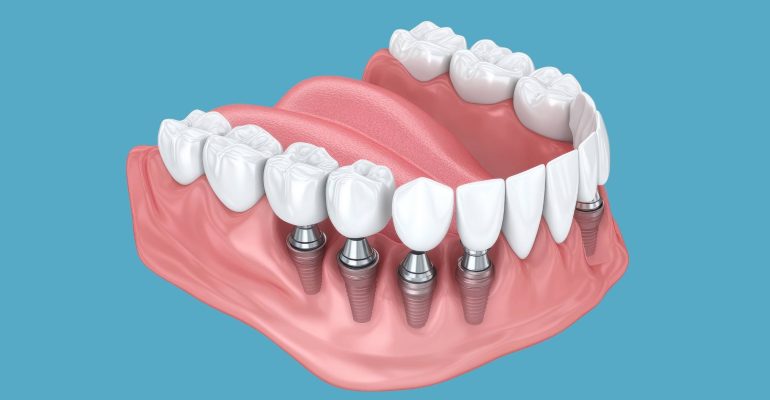 postoperatorio implante dental