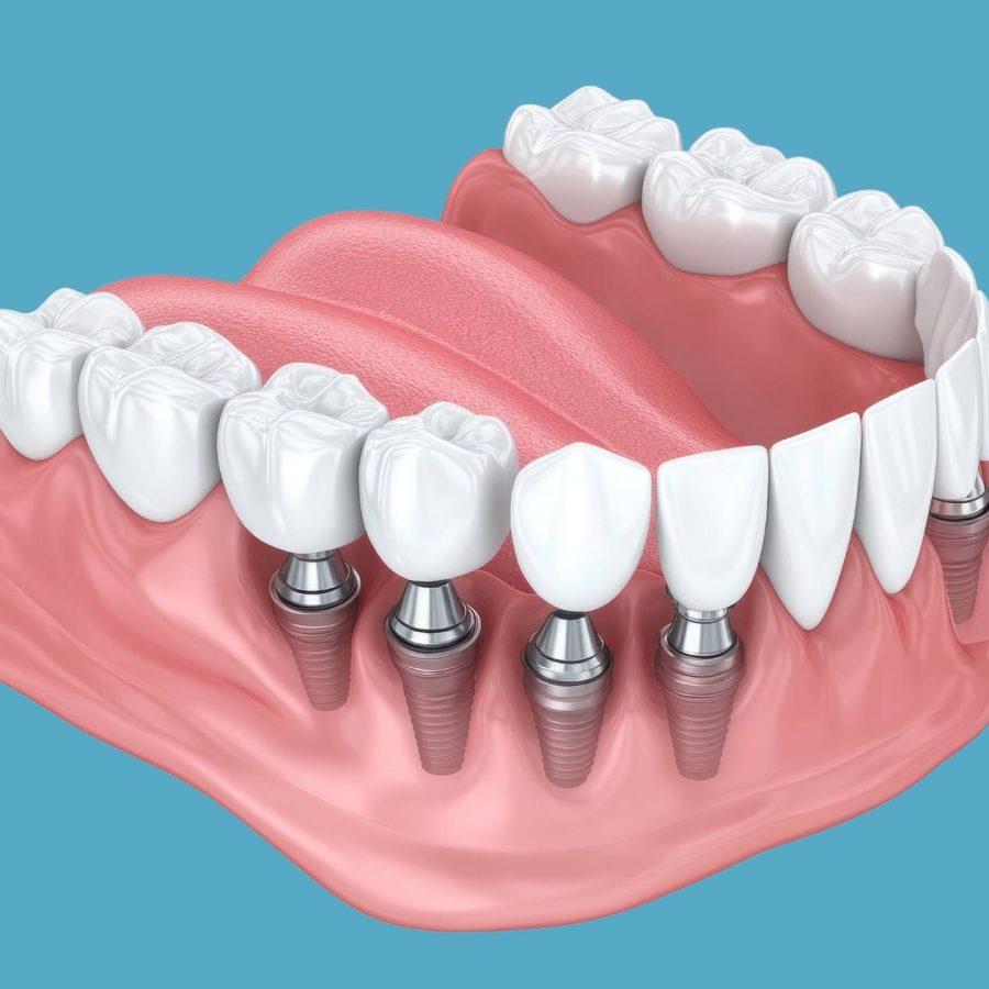 Qué esperar en el postoperatorio de implantes dentales: Guía completa para pacientes