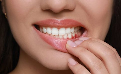 porque me sangran las encías