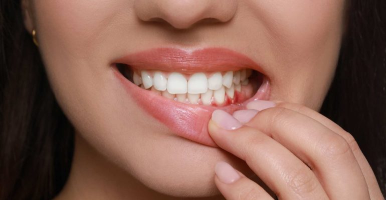 porque me sangran las encías